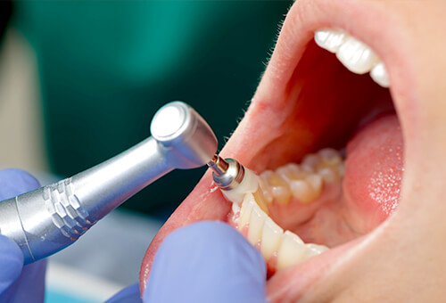 伊勢原駅・近藤歯科医院・②痛みの少ないクリーニングで歯垢・歯石を除去します
